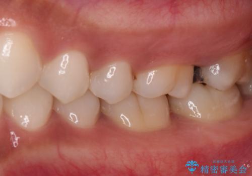 奥歯のむし歯をゴールドインレーで修復の治療前
