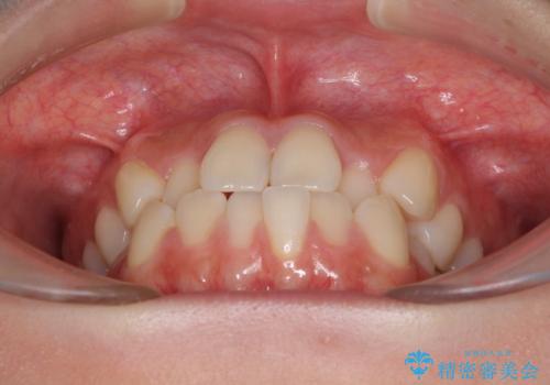 ワイヤー矯正を併用し、リスクを回避しながらのインビザライン矯正治療の治療前