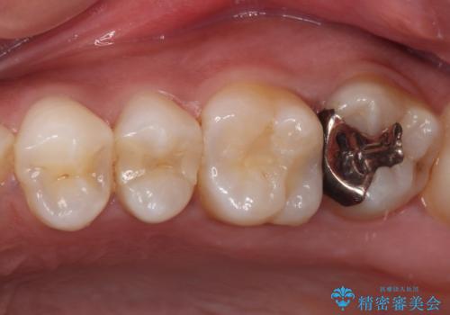 奥歯のむし歯をゴールドインレーで修復の治療前