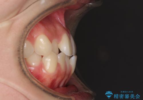 ワイヤー矯正を併用し、リスクを回避しながらのインビザライン矯正治療の治療前