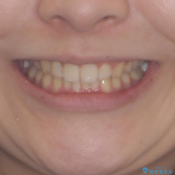 気になる八重歯を改善　補助装置併用のインビザライン治療の治療後（顔貌）