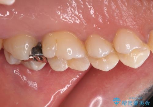 奥歯のむし歯をゴールドインレーで修復の治療前