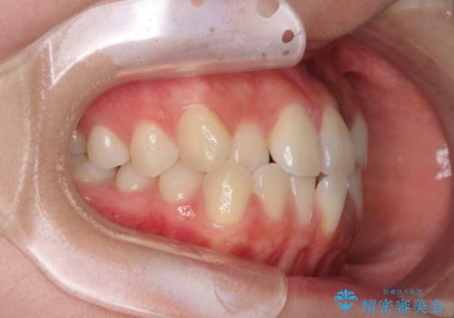 ワイヤー矯正を併用し、リスクを回避しながらのインビザライン矯正治療の治療前