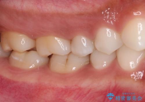 奥歯のむし歯をゴールドインレーで修復の治療前