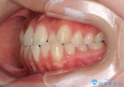ワイヤー矯正を併用し、リスクを回避しながらのインビザライン矯正治療の治療前