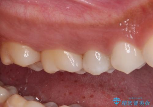 奥歯のむし歯をゴールドインレーで修復の治療前