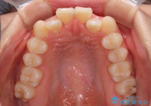 ワイヤー矯正を併用し、リスクを回避しながらのインビザライン矯正治療の治療前