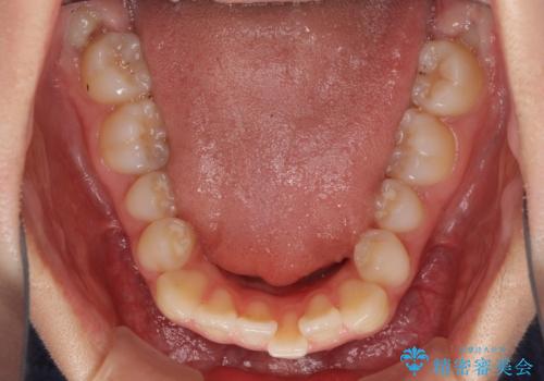 ワイヤー矯正を併用し、リスクを回避しながらのインビザライン矯正治療の治療前