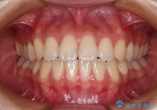 ワイヤー矯正を併用し、リスクを回避しながらのインビザライン矯正治療の症例 治療後