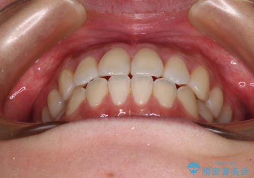 ワイヤー矯正を併用し、リスクを回避しながらのインビザライン矯正治療の治療後