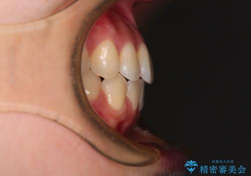 ワイヤー矯正を併用し、リスクを回避しながらのインビザライン矯正治療の治療後