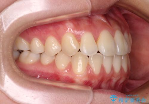 ワイヤー矯正を併用し、リスクを回避しながらのインビザライン矯正治療の治療後