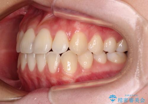 ワイヤー矯正を併用し、リスクを回避しながらのインビザライン矯正治療の治療後