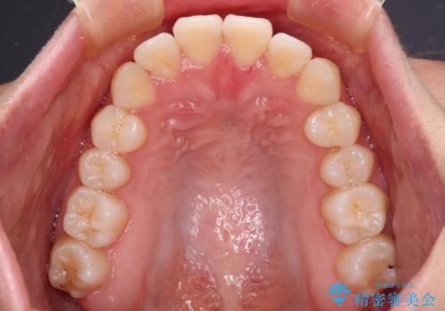 ワイヤー矯正を併用し、リスクを回避しながらのインビザライン矯正治療の治療後