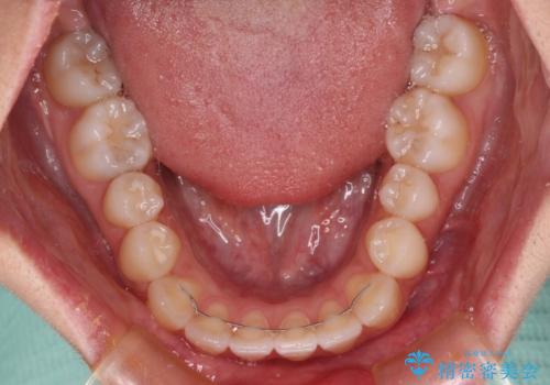 ワイヤー矯正を併用し、リスクを回避しながらのインビザライン矯正治療の治療後