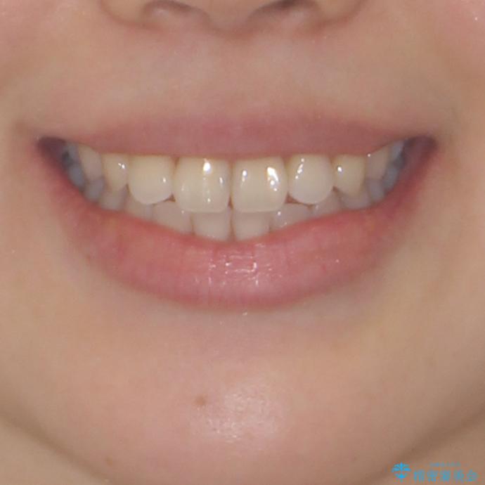 ワイヤー矯正を併用し、リスクを回避しながらのインビザライン矯正治療の治療後(顔貌)