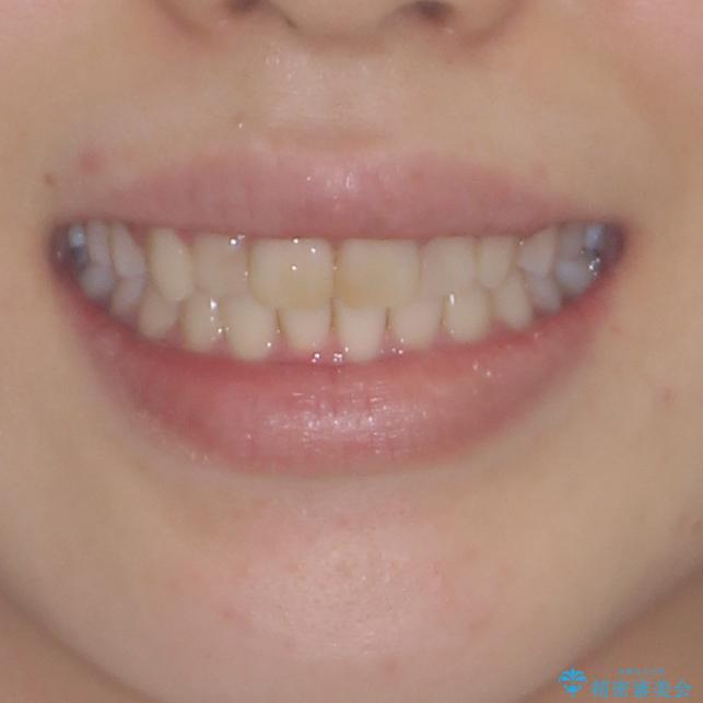 気になる前歯を治したい インビザラインで気づかれずに矯正治療の治療後(顔貌)