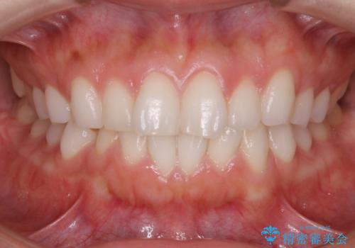 短期間でも見た目が変わる!インビザラインのスピード治療の症例 治療前