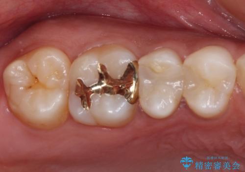 奥歯のむし歯をゴールドインレーで修復の治療後