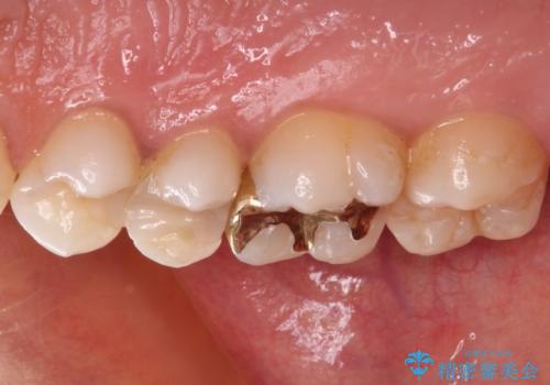 奥歯のむし歯をゴールドインレーで修復の治療後