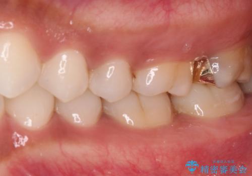 奥歯のむし歯をゴールドインレーで修復の治療後
