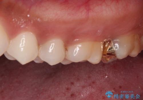 奥歯のむし歯をゴールドインレーで修復の治療後