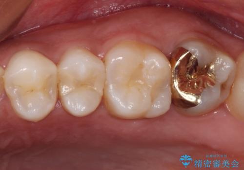 奥歯のむし歯をゴールドインレーで修復の治療後