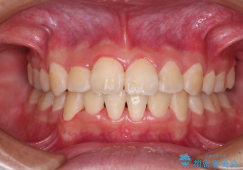 八重歯で正中が右にずれている　ワイヤー装置での抜歯矯正で正中位置を改善
