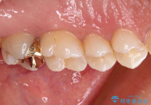 奥歯のむし歯をゴールドインレーで修復の治療後
