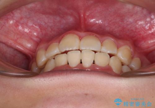 八重歯で正中が右にずれている ワイヤー装置での抜歯矯正で正中位置を改善の治療後