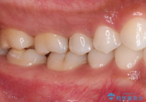 奥歯のむし歯をゴールドインレーで修復の治療後