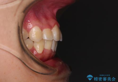 八重歯で正中が右にずれている ワイヤー装置での抜歯矯正で正中位置を改善の治療後