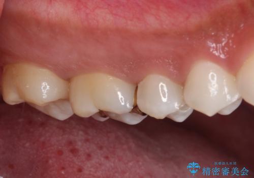 奥歯のむし歯をゴールドインレーで修復の治療後