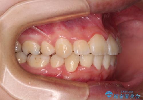 八重歯で正中が右にずれている ワイヤー装置での抜歯矯正で正中位置を改善の治療後