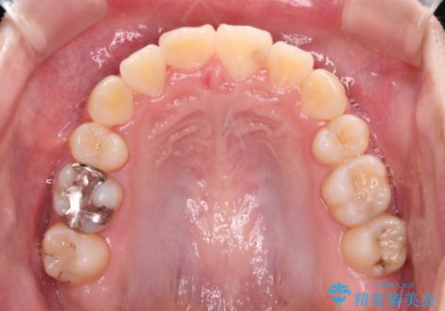 八重歯で正中が右にずれている ワイヤー装置での抜歯矯正で正中位置を改善の治療後