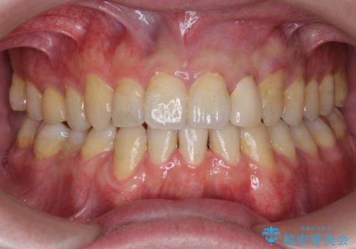 前歯の矮小歯 奥歯の反対咬合 をインビザラインでの治療中