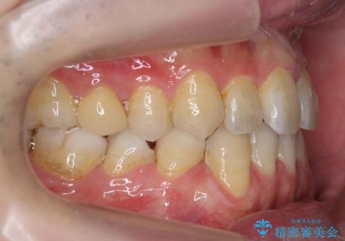 前歯の矮小歯　奥歯の反対咬合　をインビザラインでの治療中