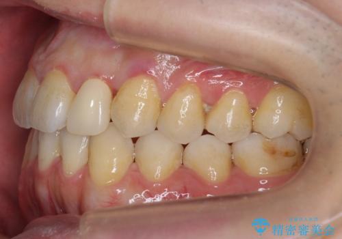 前歯の矮小歯 奥歯の反対咬合 をインビザラインでの治療中