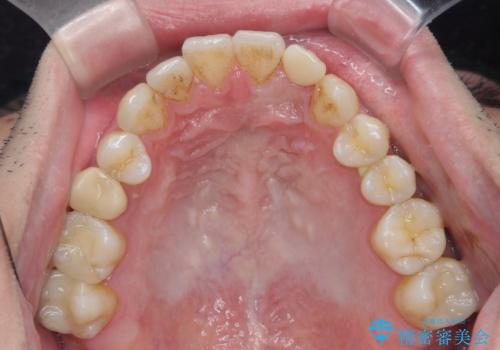 前歯の矮小歯　奥歯の反対咬合　をインビザラインでの治療中