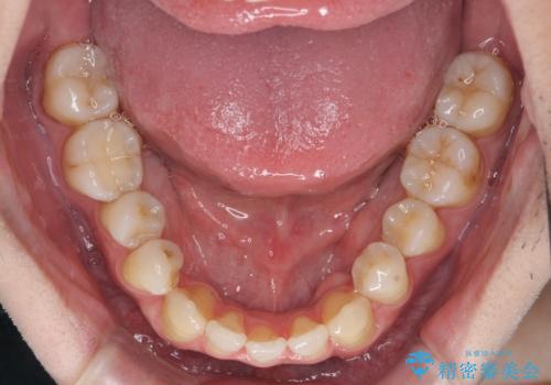 前歯の矮小歯 奥歯の反対咬合 をインビザラインでの治療中