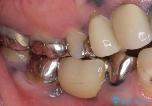 痛む奥歯 目立つ銀色の奥歯をセラミックに セラミックブリッジの治療前