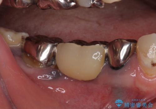 痛む奥歯 目立つ銀色の奥歯をセラミックに セラミックブリッジの治療前