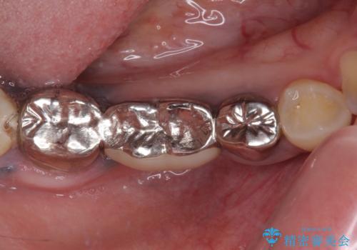 痛む奥歯　目立つ銀色の奥歯をセラミックに　セラミックブリッジの症例 治療前
