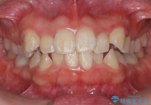 八重歯・前歯のがたつき 抜かない矯正 インビザラインでの治療中