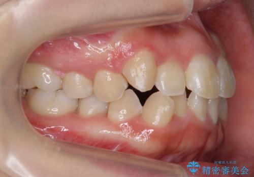 八重歯・前歯のがたつき　抜かない矯正　インビザラインでの治療中