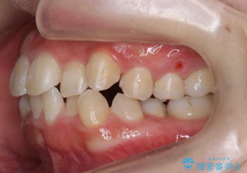 八重歯・前歯のがたつき 抜かない矯正 インビザラインでの治療中