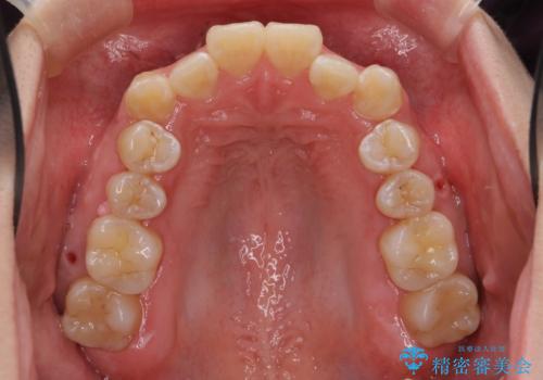 八重歯・前歯のがたつき　抜かない矯正　インビザラインでの治療中