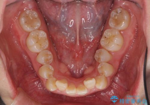 八重歯・前歯のがたつき 抜かない矯正 インビザラインでの治療中