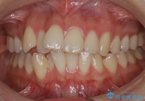 非抜歯でも劇的変化　インビザライン矯正治療の症例 治療前