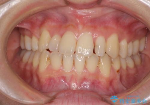 八重歯の抜歯矯正 補助装置を用いたインビザライン矯正の治療中